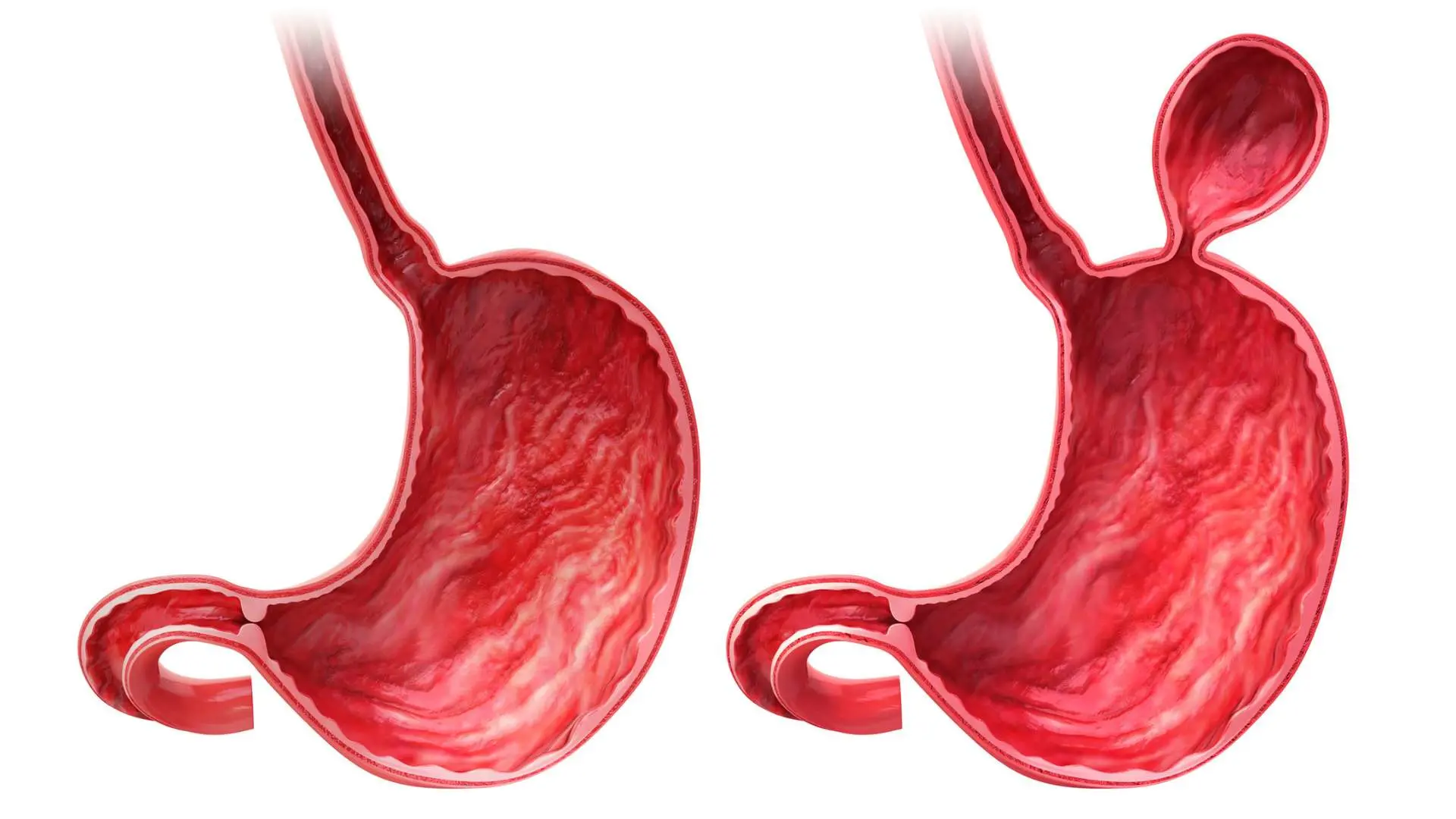 Hérnia De Hiato Doença Diverticular | Dr. Arthur Arrais | Gastroenterologista