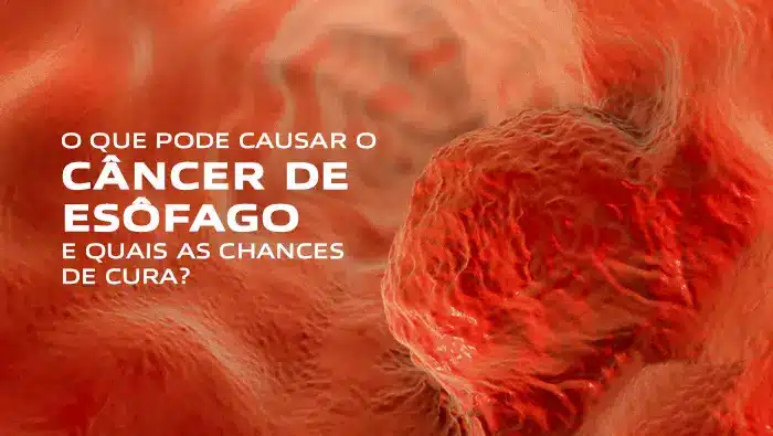 O que pode causar o câncer de esôfago | Dr. Arthur Arrais | Gastroenterologista